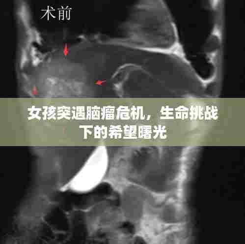 女孩突遇脑瘤危机,生命挑战下的希望曙光